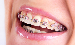 Types of Braces - Whistler Orthodontic Center